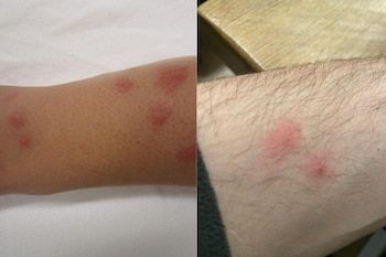 Bites of different workers of the