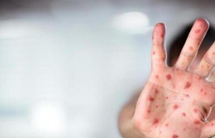 The EU alerts the increase in measles due to the fall of vaccination rates