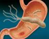 They alert by high infection rate of a type of gastric bacteria in Chile