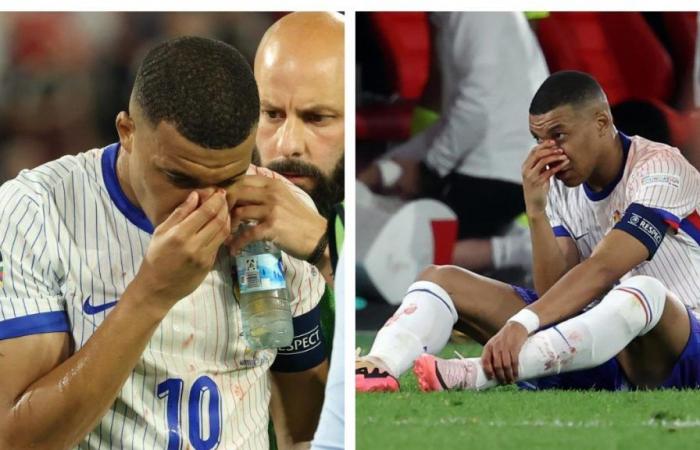Kylian Mbappé must undergo surgery after a severe blow to his nose, according to the French press: is the Euro Cup in danger?