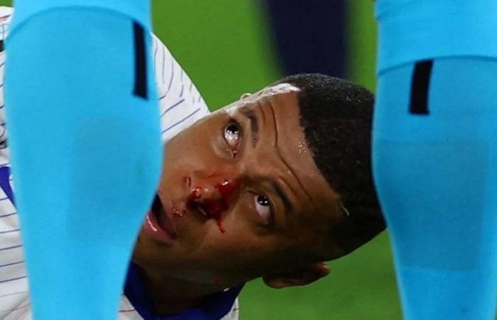 Concern in France: Mbappé broke his nose in his debut and could miss the rest of the Euro Cup