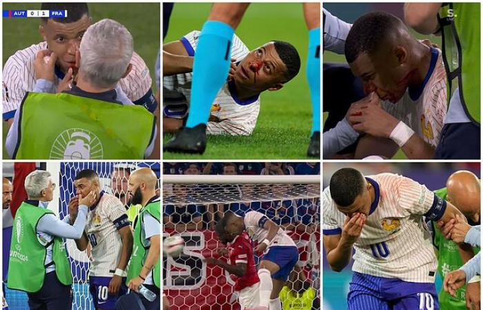 It hurts to see it! This is how Mbappé’s nose looked after his strong blow with Danso