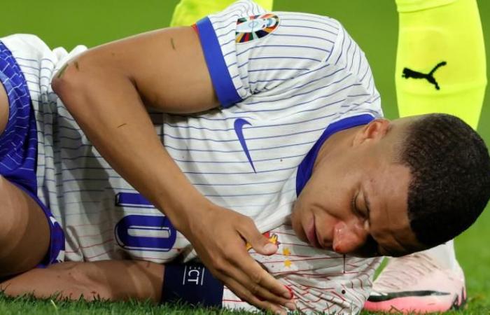 His nose injury during France vs. Austria for the Euro Cup