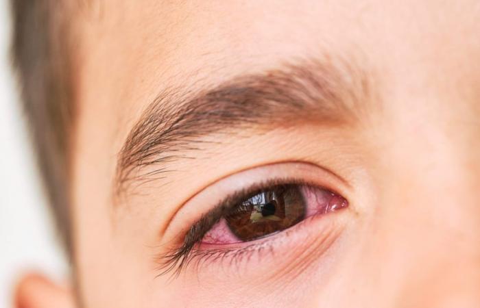 Most children receive antibiotics for conjunctivitis, but experts believe they are not necessary
