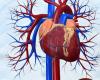 You May Not Need to Fast Before Cardiac Cath, Study Suggests