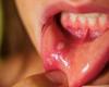 Why canker sores appear and how to avoid them