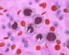 Phase III RESONATE-2 Study Confirms Sustained PFS Benefit of Imbruvica in CLL